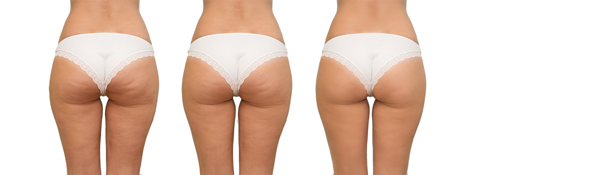 Stadien der Cellulite